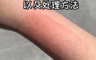 膏药贴多久换一次_膏药过敏怎么办