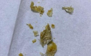 吃了耳屎会怎么样_耳屎有毒吗