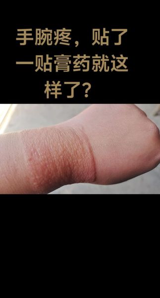 膏药贴多久换一次_膏药过敏怎么办-第3张图片-俊逸知识馆 膏药贴多久换一次_膏药过敏怎么办-第3张图片-俊逸知识馆