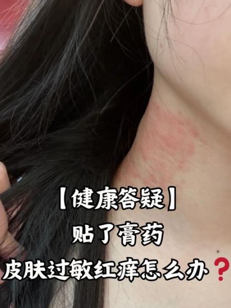 膏药贴多久换一次_膏药过敏怎么办-第2张图片-俊逸知识馆 膏药贴多久换一次_膏药过敏怎么办-第2张图片-俊逸知识馆